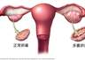 终于改名!这个病困扰全球1.7亿女性,却被“叫错”90年