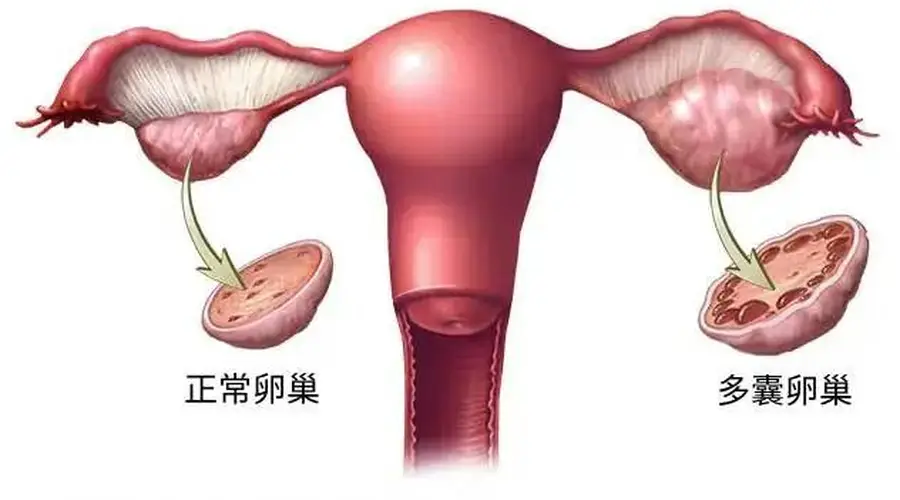 终于改名!这个病困扰全球1.7亿女性,却被“叫错”90年