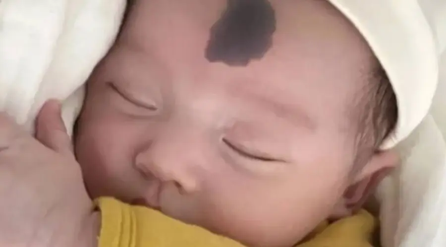 新生儿长胎记怎么办？妇产科大夫提醒：孕期避开这4类行为减少胎记概率