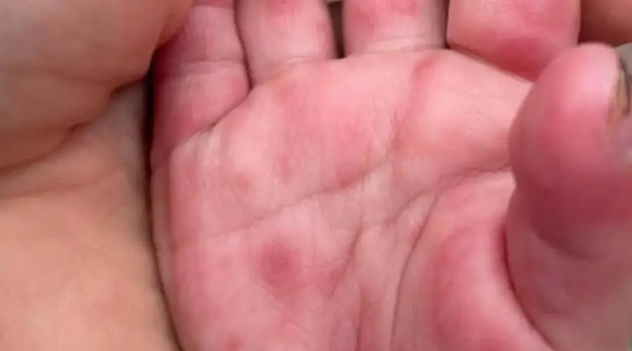 手足口病居家消毒指南:有效阻断病毒传播