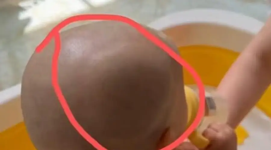 宝宝从餐椅跌落，家中老人不敢告知孩子父母，两天后孩子确诊头骨骨折