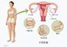 杭州一女子常被误认怀孕,腹中竟藏着50颗子宫肌瘤
