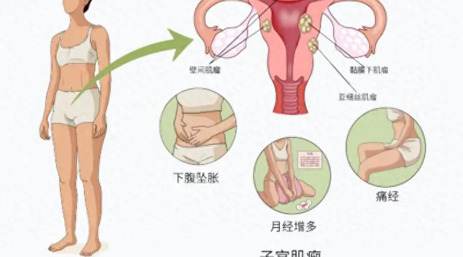 杭州一女子常被误认怀孕,腹中竟藏着50颗子宫肌瘤