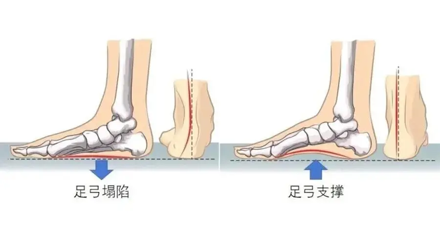 6种网红鞋竟成“脚伤凶手” 多数人天天穿还踩雷